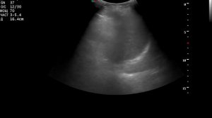 Увеличение размеров селезенки