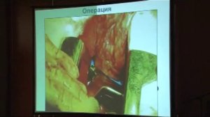 Лечение метастазов колоректального рака в легких