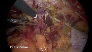 eTEP RS repair of a Umbilical Hernia. Лечение пупочной грыжи