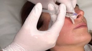 Linerase Collagen Stimulator