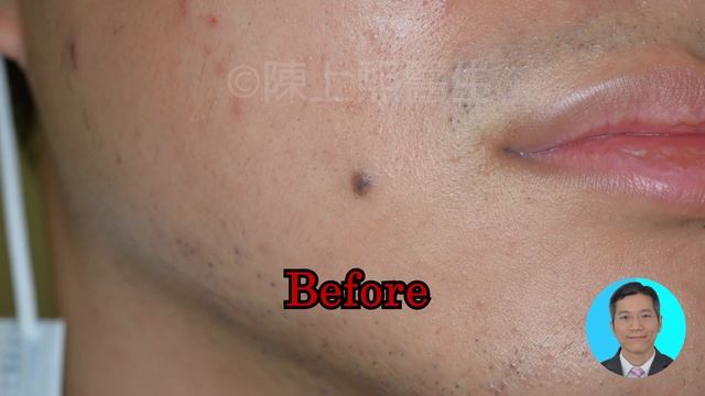二氧化碳激光脫痣/脫墨 | Co2 laser mole removal | nevus | skin cancer | 皮膚癌 | 陳上熙醫生 | 皮膚專科 | Dermatologist смотреть онлайн