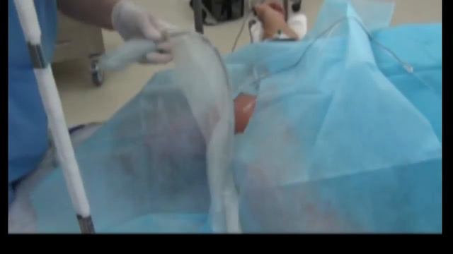 Глубокая блокада шейного сплетения смотреть онлайн