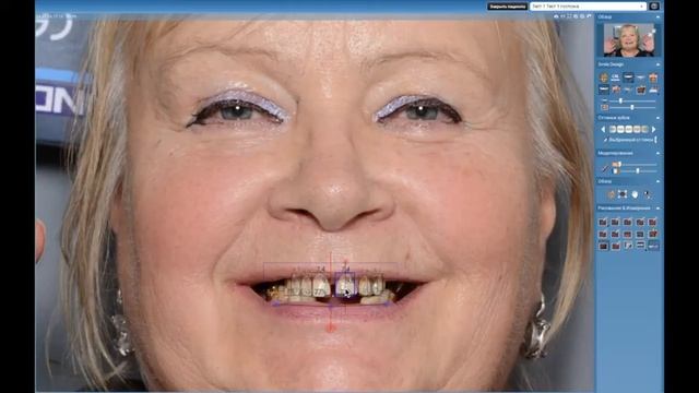 ?⚕️ Вебинар Romexis Smile Design