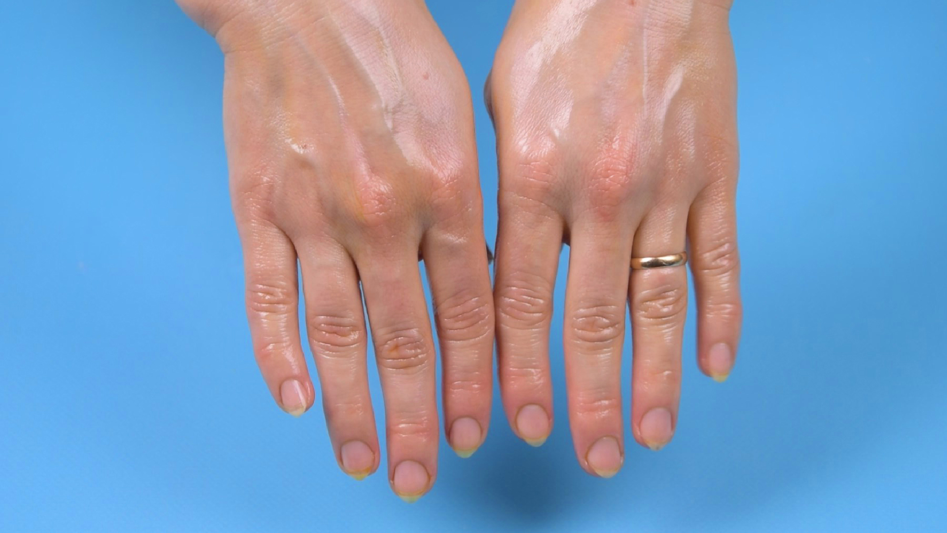 Сухая морщинистая кожа рук