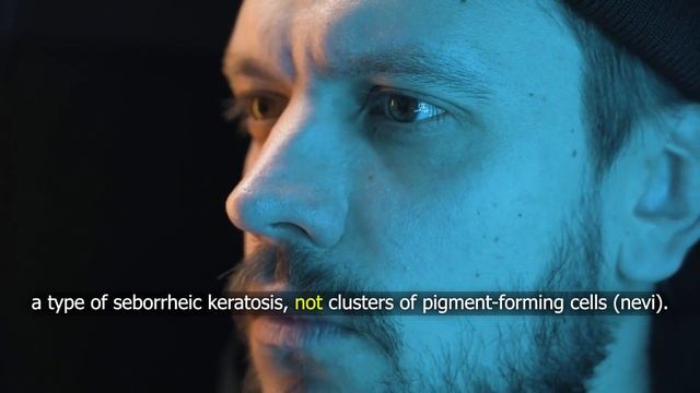 You have to see doctor if you have this type of mole! смотреть онлайн