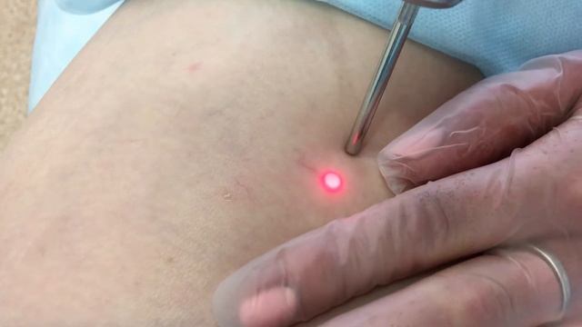 Удаление сосудов на аппарате Fotona смотреть онлайн