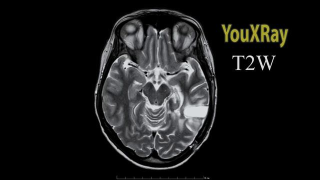 Базовые лекции по МРТ / МР-последовательности: T2W
