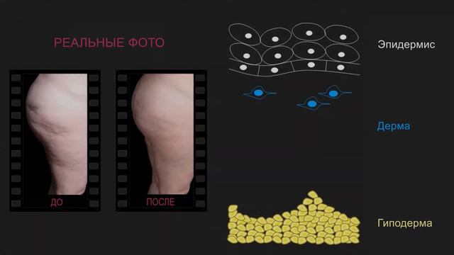 Как быстро избавиться от целлюлита уже через месяц? смотреть онлайн