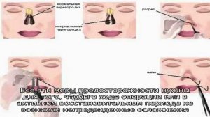 Исправление перегородки носа