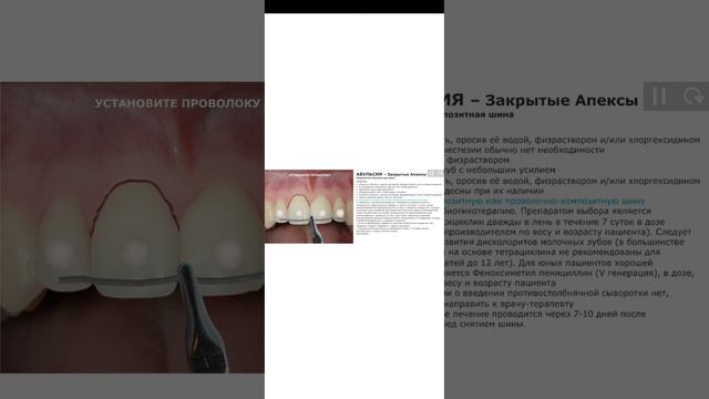 Авульсия (полный вывих). Зуб в сухих условиях менее 60 мин. Лечение молочных зубов смотреть онлайн