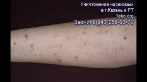 Как выглядят укусы клопов