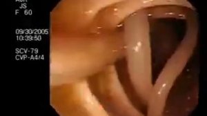 2 Аскарида в кишечнике1