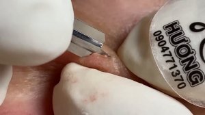 Make your Acne Treatment Huong Da Nang#502 | acne 2022 PArt 1