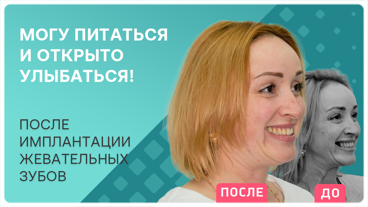 Имплантация жевательных зубов – как ставятся импланты Straumann