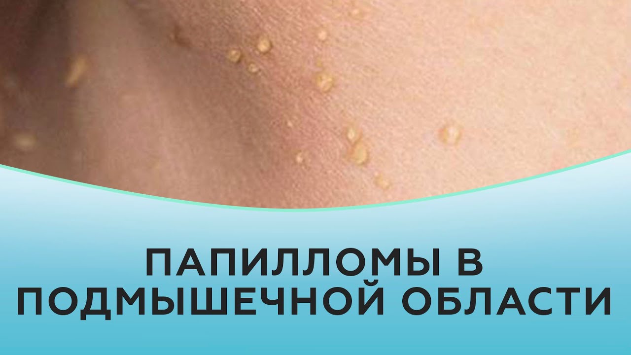 Папилломы в подмышечной области.