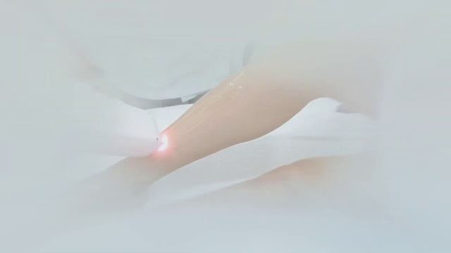 Лазерная эпиляция волос | Студия красоты «Эсте» в Таганроге смотреть онлайн