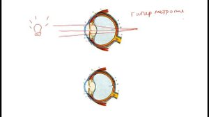 Рефракция глаза