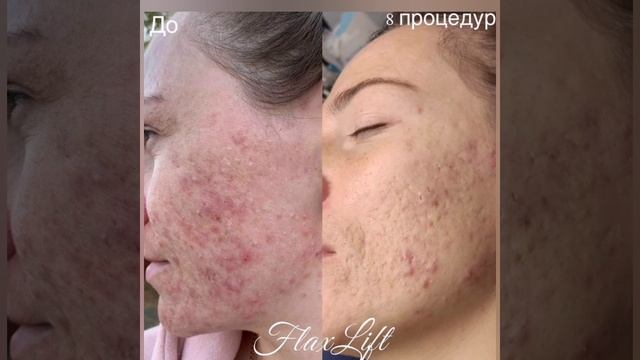 Что такое FlaxLift? 