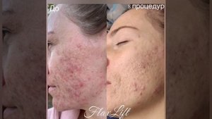 Что такое FlaxLift? ?