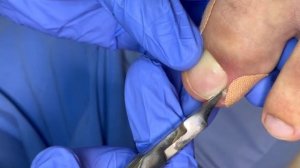 Вросший ноготь ⚠️❗️???