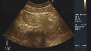 Объемное образование мягких тканей левого бедра на УЗИ