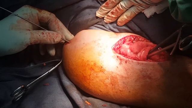 Блокирующий остеосинтез перелома плеча, humerus nailing , ORIF часть 1 смотреть онлайн