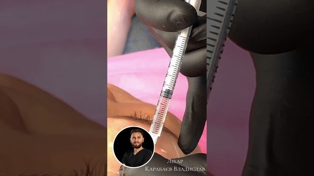 Ботулінотерапія препаратом Ботокс смотреть онлайн