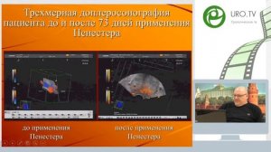 Образовательная лекция д м н , проф  Мартова А Г  «ДГПЖ – консервативное или оперативное лечение: к