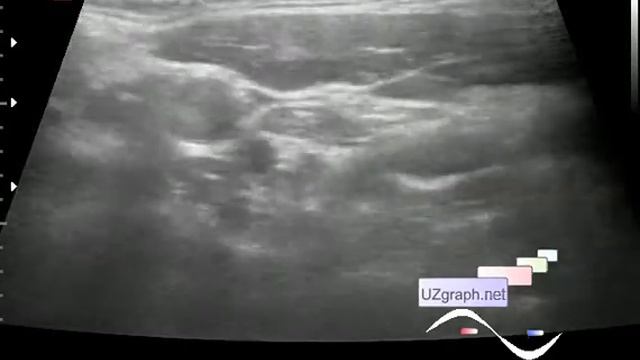 Pediatric Thyroid ultrasound - lesion with a solid-cystic echo-pattern смотреть онлайн