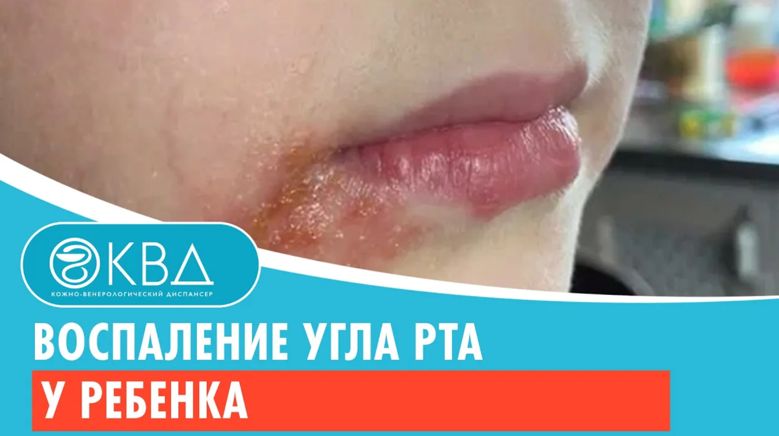 ? Воспаление угла рта у ребенка. Клинический случай №705