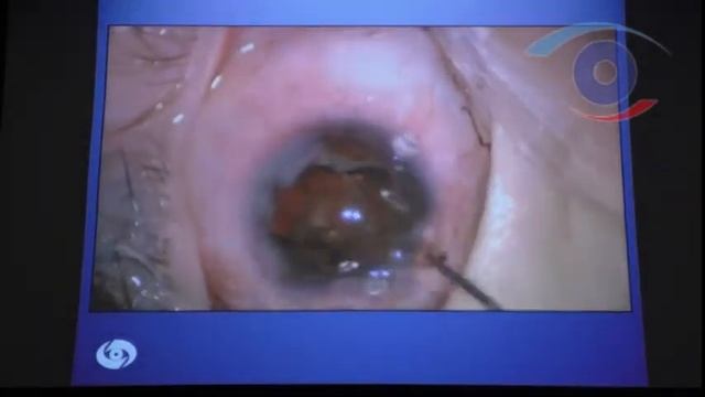 Удаление ИОЛ смотреть онлайн