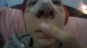 РИНОПЛАСТИКА | НОВЫЙ НОС | МОИ СТРАДАНИЯ ??