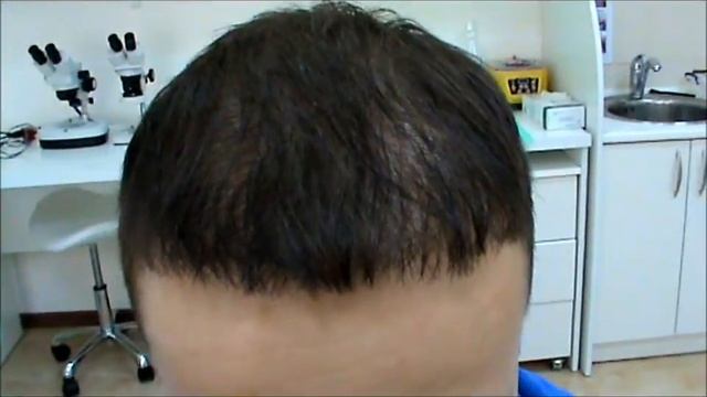 Результат До и После пересадки смотреть онлайн