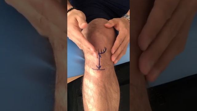 Тендинит собственной связки надколенника (Колено прыгуна) смотреть онлайн