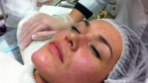 Чистка лица механическая