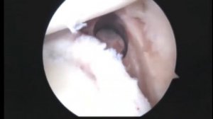 SG L arthroscopic rotator cuff and biceps tenodesis 11.4.13