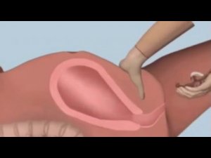 Ручное отделение плаценты.