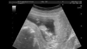 😻😻 УЗИ.12 недель. Монохориальная беременность-двойня. Ultrasound -twins.Поля и Даша в животике