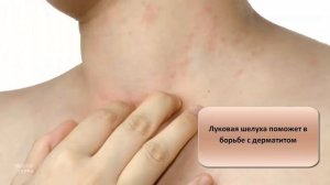 Лечебные свойства луковой шелухи