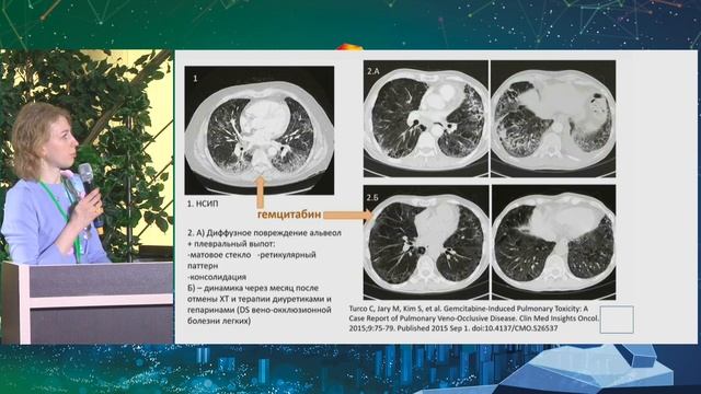 11 Интерстициальные изменения в легких у пациентов онкопрофиля Комогорцева Ирина Александровна смотреть онлайн