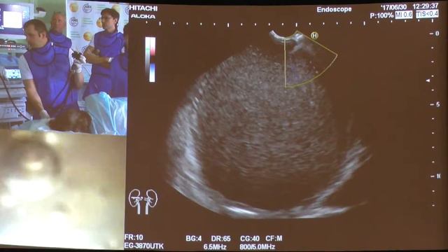 09Live Бурдюков МС Гигантская псевдокиста поджелдочной железы EUS дренирование PENTAX смотреть онлайн