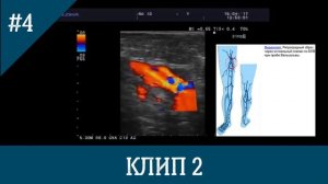 УЗИ вен. Несостоятельность СФС. Имитация состоятельности устья БПВ при пробе Вальсальвы.