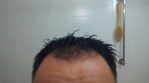 Микронидлинг & эфирные масла против выпадения волос  / Microneedling & essential oils Anti Hair Los