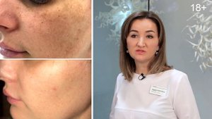 Шлифовка лица и коррекция дефектов с помощью лазера (лазерная шлифовка)