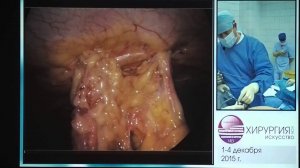 4   КС 02   А В  Сажин   Лапароскопическая Герниопластика Рецидивной Послеоперационной Вентральной Г