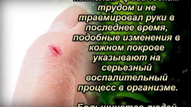 Первые Симптомы РАКа Проявляются на РУКАХ! Худшее, что Можно Сделать, — ПРОИГНОР