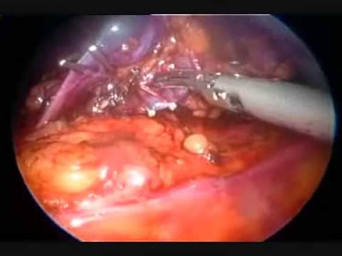лапароскопическое удаление селезенки Аболмасов А.В. смотреть онлайн