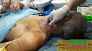 Межлестничная блокада плечевого сплетения