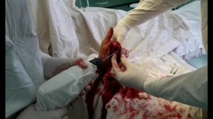 Блок плечевого сплетения по Куленкампфу. Brachial plexus block paresthesia technique