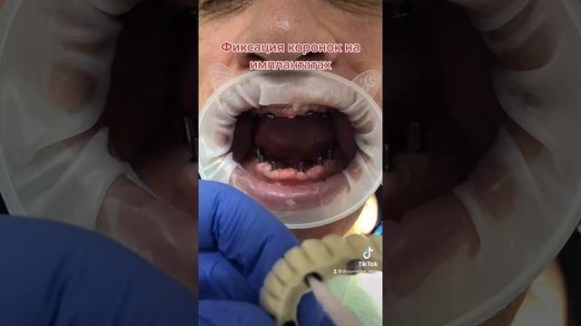 Фиксация коронок на имплантаты ! смотреть онлайн
